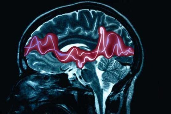 خاموش کردن مغز راهی برای درمان صرع