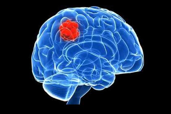 نشانه های دهگانه بروز تومور مغزی