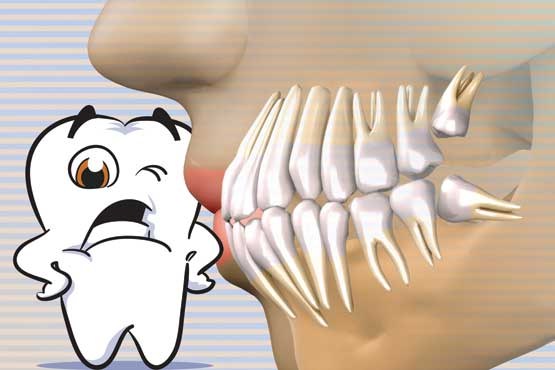 جراحی دندان عقل مفید یا غیرمفید؟
