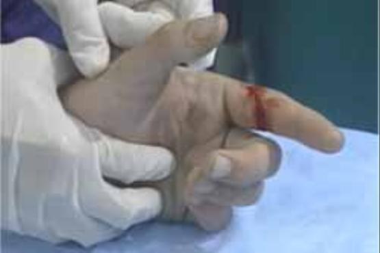 تشخیص و درمان پارگی در تاندون دست