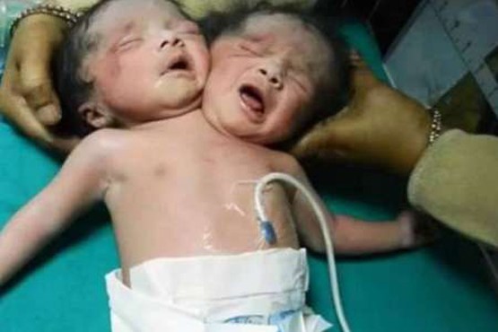 تولد نوزاد دو سر در هند