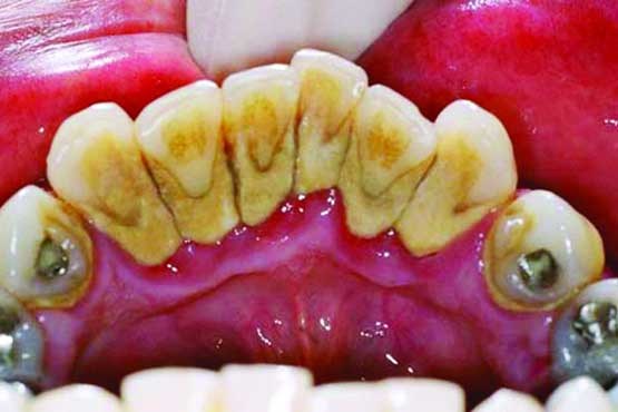 جرم دندان موجب تحلیل بافت لثه می‌شود