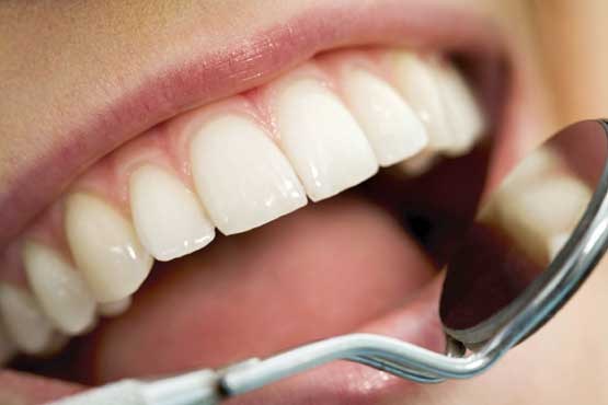 انواع و بهترین روش‌های سفید کردن دندان