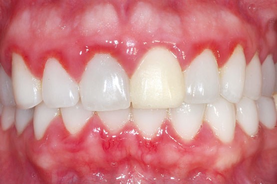 عفونت لثه و دندان را جدی بگیرید