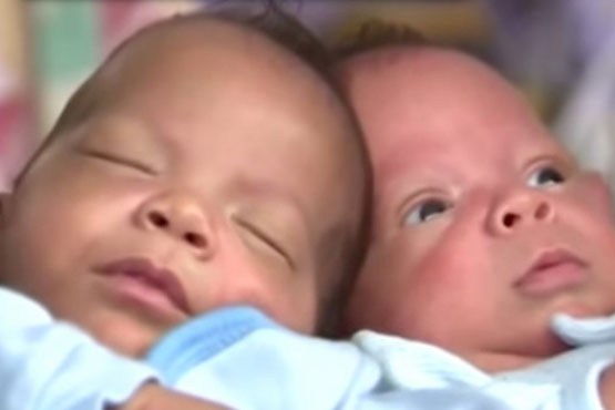 دوقلوهایی که با 24 روز تاخیر از یکدیگر به دنیا آمدند