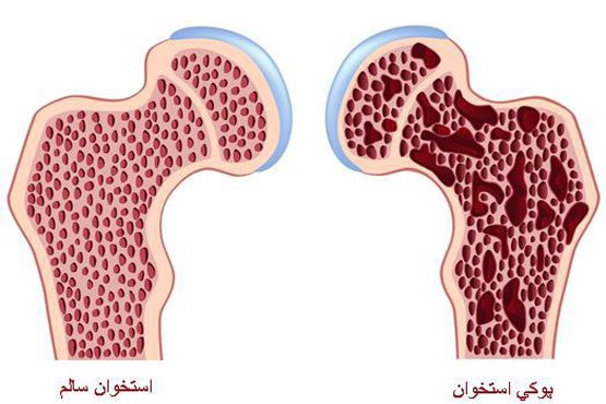 انواع پوکی استخوان و راه‌های درمان