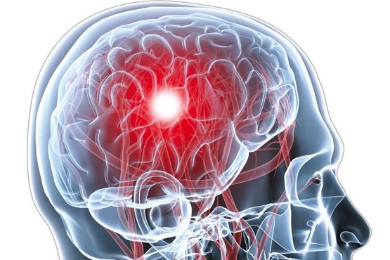 نشانه‌های هشداردهنده که خبر از سکته مغزی می دهند/ 3 ساعت حیاتی برای نجات بیماران سکته مغزی