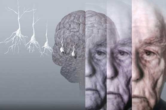 هر 4 ثانیه یک نفر در جهان به آلزایمر مبتلا می شود