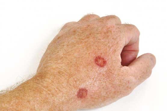 پیشگیری از ابتلا به سرطان پوست با استفاده از کرم های ضدآفتاب