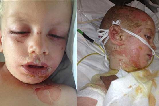 پسری با دردناک ترین بیماری پوستی + عکس