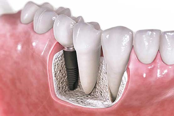 راه‌هایی برای مهار عفونت و بادوام کردن ایمپلنت دندان