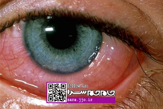 7 علت رایج لکه های خونی داخل چشم
