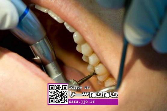 آیا عصب‌کشی یا درمان کانال ریشه، دندان‌ها را ضعیف می‌کند؟