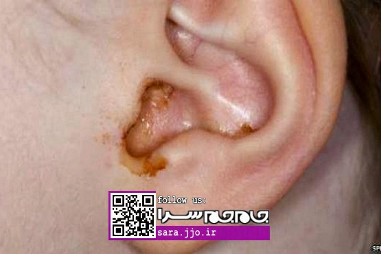 دلایل عفونت گوش چیست؟