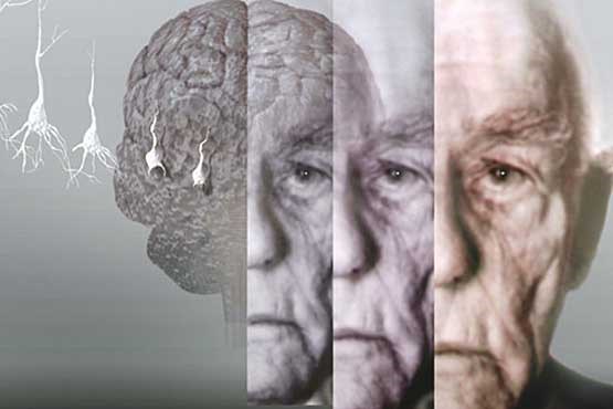 آهسته راه رفتن سالخوردگان نشانه آلزایمر است