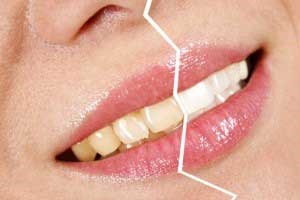 زردی دندان هایتان را به کمک فویل آلومینیوم محو کنید!