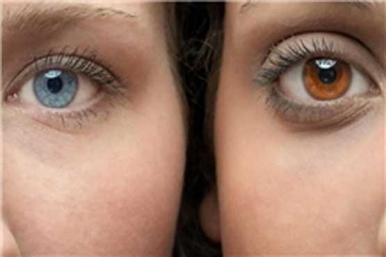 عمل جراحی خطرناک برای آبی‌شدن رنگ چشم‌ها