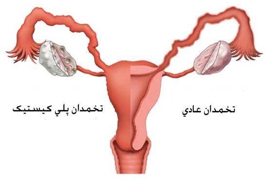 تصویر اختلالات هورمونی ، تهدید جدی برای ناباروری زنان