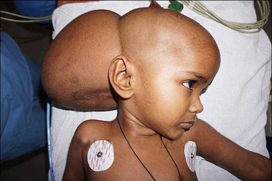 تومور ۳ کیلویی در سر یک دختر! + عکس