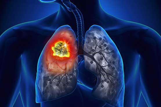 نقش مهم ساعت بدن در ابتلا به بیماری فیبروز ریه