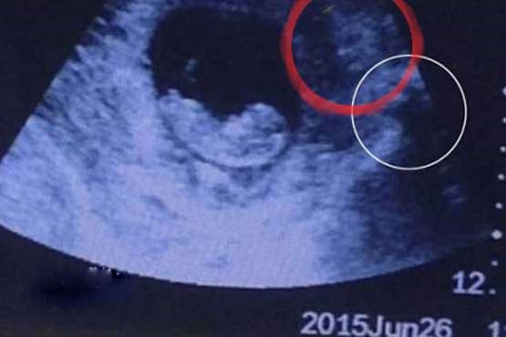 شیطان در شکم زن باردار! + عکس