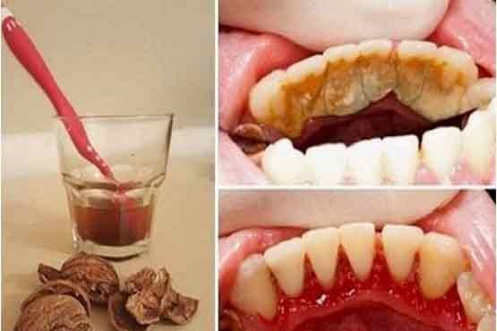 چگونه "جرم دندان" را بدون هزینه از بین ببریم؟