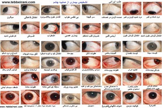 بیماریهای رایج چشمی را بشناسید
