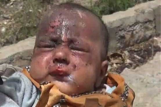 جان باختن ۱۲۴۸ کودک یمنی بر اثر حملات عربستان