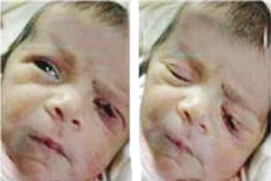 علت پارگی پلک نوزاد نطنزی اعلام شد