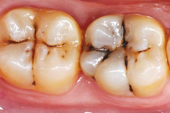 مراقب پوسیدگی دندان ها باشید