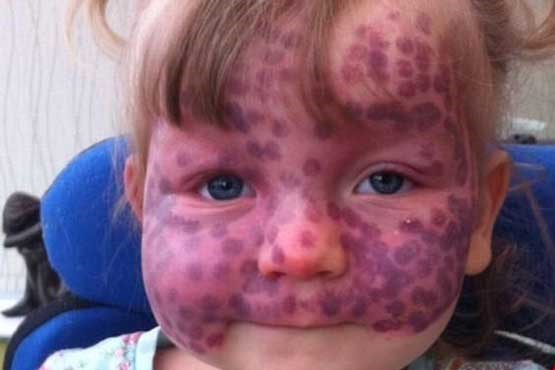 ماه‌گرفتگی نادر روی پوست یک کودک +عکس