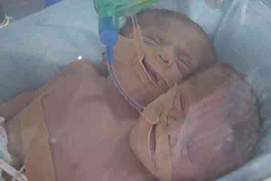 تولد نوزاد دو سر در نوار غزه