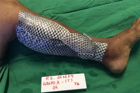 درمان سوختگی‌ با پوست ماهی تیلاپیا +عکس