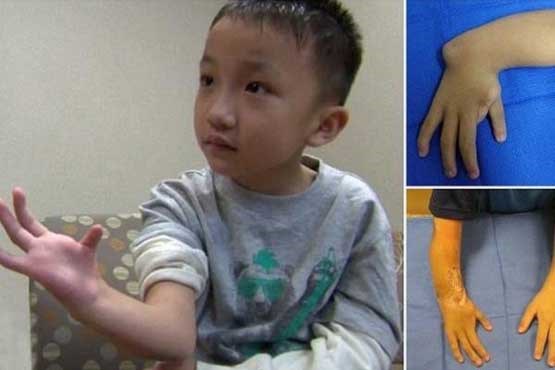 درمان دست معلول کودک با استخوان پا +عکس