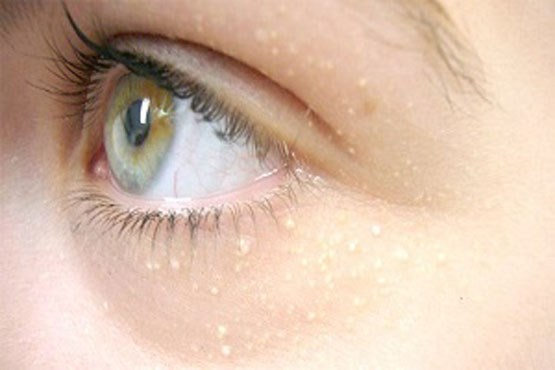 چگونه دانه‌های سفید اطراف چشم را درمان کنیم؟