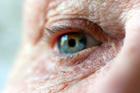 معاینه چشم راهکاری برای تشخیص زودهنگام آلزایمر