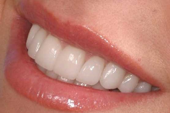 آنچه برای پیشگیری از خرابی دندان باید بدانید