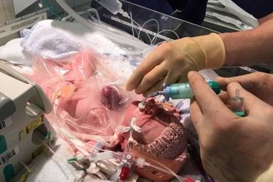 نجات نوزادی که قلبش بیرون بدنش بود + عکس