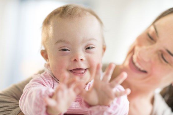 احتمال بچه دار شدن در بیماران مبتلا به سندرم داون
