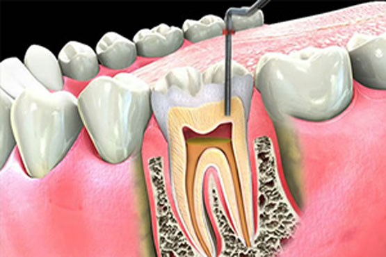 عصب کشی دندان چگونه انجام می‌شود؟ + فیلم