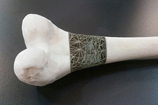 درمان سرطان استخوان با استفاده از چاپگرهای سه بعدی