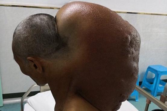 ۱۵ کیلو تومور پشت گردن مرد چینی + عکس