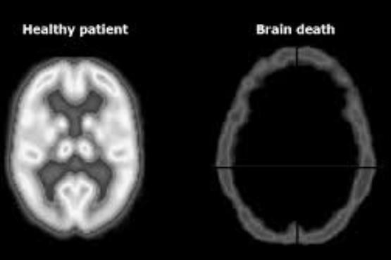 مراحل تایید مرگ مغزی چگونه است؟