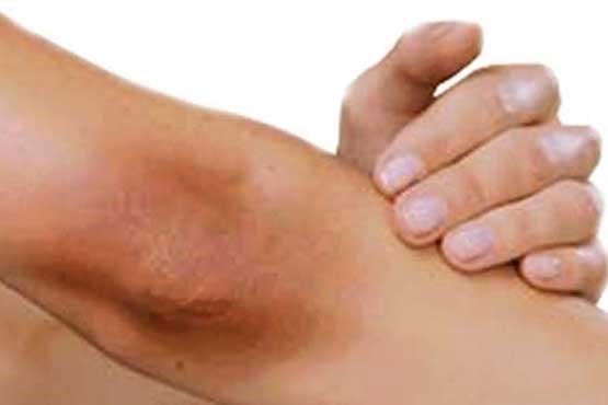 درمان تیرگی زانو‌ و آرنج با طب سنتی