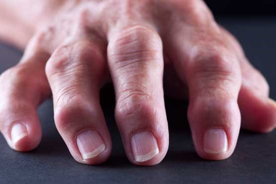 راهکار کاهش درد آرتروز انگشتان