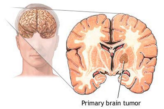 درمان سرطان مغز با سلول های چربی