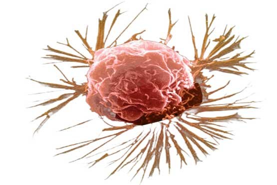 سرطان سینه  قابل پیشگیری و درمان است