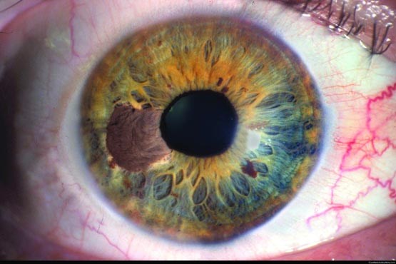 چشم در چشم سرطان