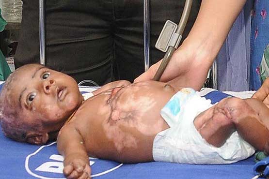 ابتلای نوزاد هندی به بیماری عجیب خودسوزی