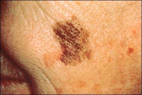 4 عاملی که احتمال  ابتلا به سرطان پوست را افزایش می دهد
